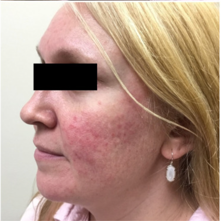 Por qué tengo manchas rojas en la piel: posibles causas y tratamientos